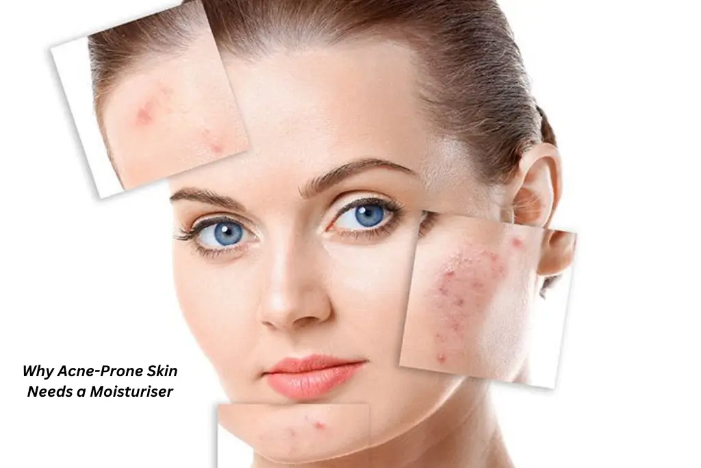 acne-moisturise