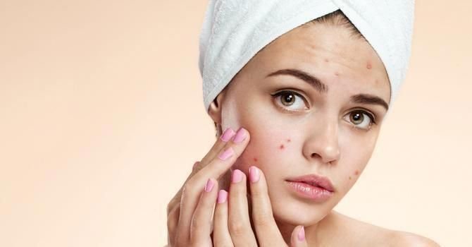 Top Moisturisers for Acne-Prone Skin